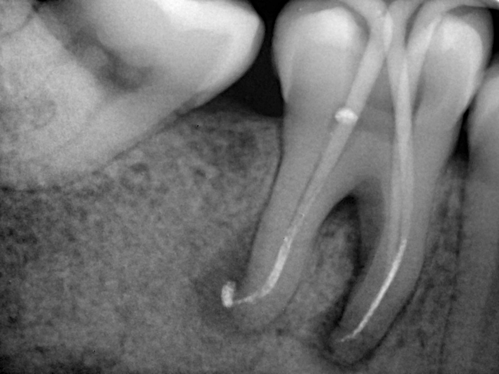 Perawatan Saluran Akar