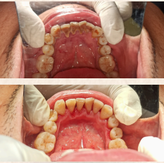 Pembersihan Karang Gigi