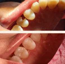 Pulp Capping / Cariesstop