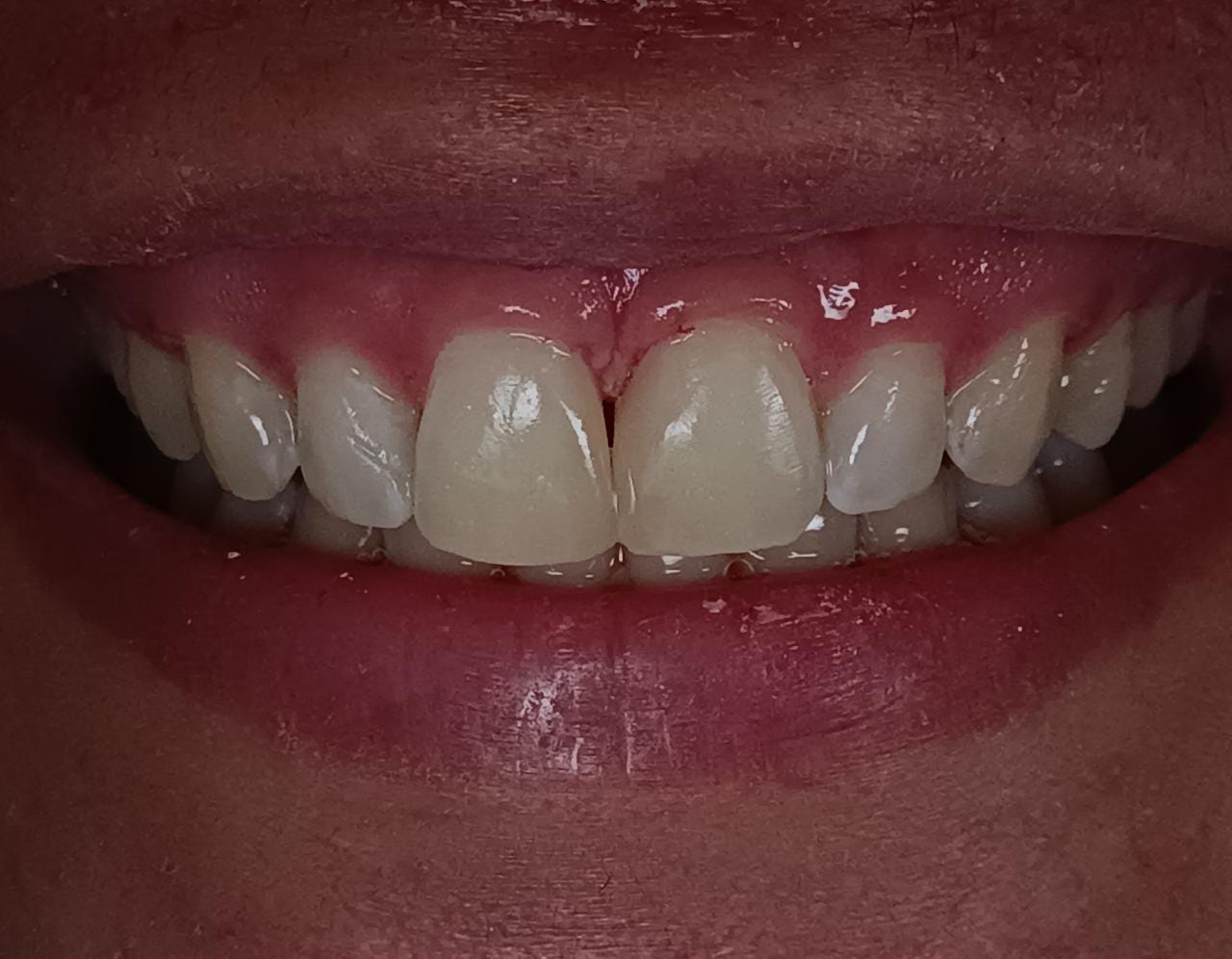Veneer Direct